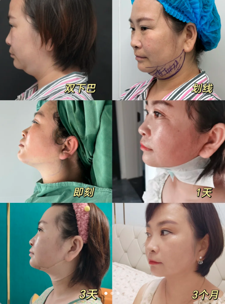 下巴吸脂