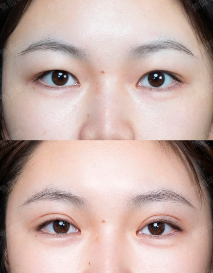 昆明割双眼皮哪个医生好？焦圆华和汤婷医生哪个割双眼皮自然？
