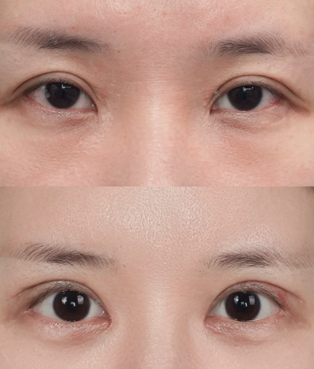 上海双眼皮修复管果和佀同帅哪个医生技术好？谁的案例更好看些？