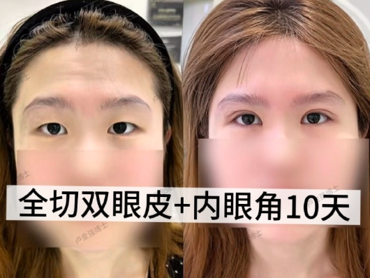 广州卢金强医生做双眼皮口碑怎么样？卢金强双眼皮案例预约电话