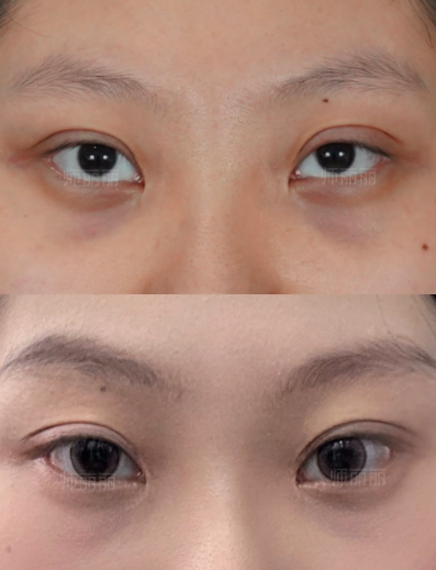 北京双眼皮修复师丽丽和李燕哪个医生做眼修复技术好？