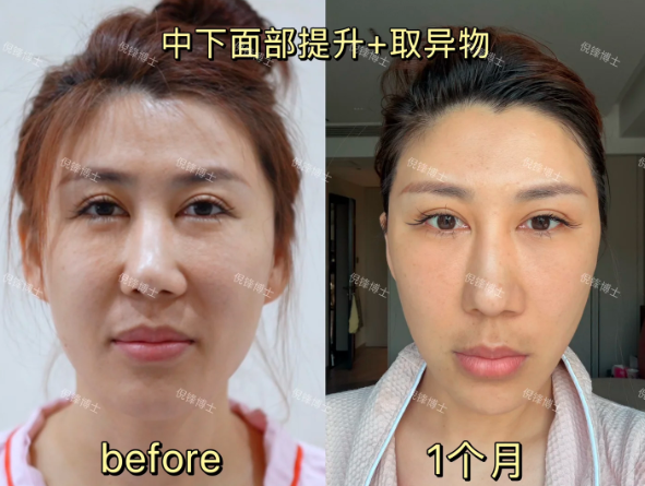 上海拉皮倪锋医生怎么样？技术口碑好不好？倪锋面部提升案例多不多？