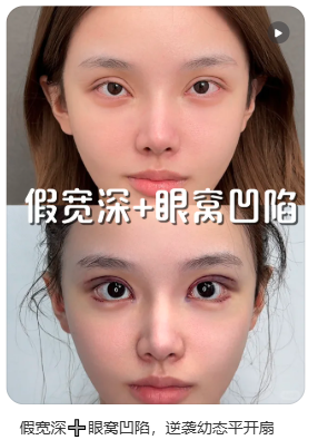 上海刘于宾双眼皮修复技术怎么样?刘于宾眼修复口碑好不好?