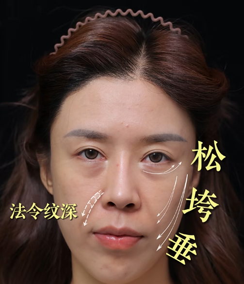 北京陈凤超医生做面部提升技术怎么样?陈凤超筋膜提升复位效果好不好?收费贵不贵?