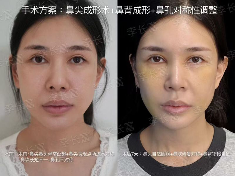 北京李长富做高难度鼻修复技术怎么样？真的像宣传的那么好吗？