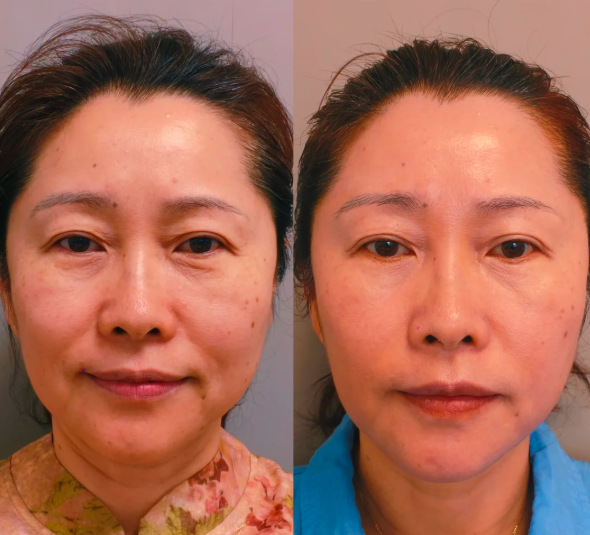 西安李超做拉皮技术靠谱吗?李超面部提升技术怎么样?大概收费多少?