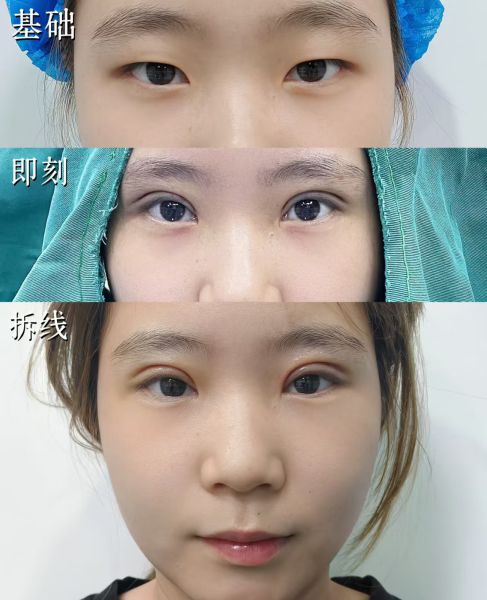 惠州第三人民医院王存富做双眼皮怎么样？王存富双眼皮大概多少钱？