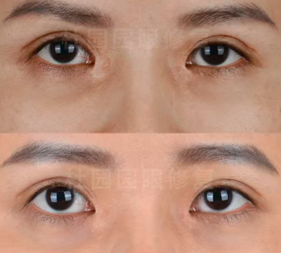 上海杜园园做双眼皮修复技术怎么样？杜园园眼修复口碑好不好？大概收费多少？