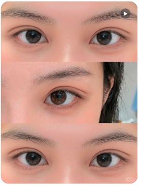 哈尔滨双眼皮医生推荐哪个?2026年哈尔滨做双眼皮最好的医生预约排行榜大全