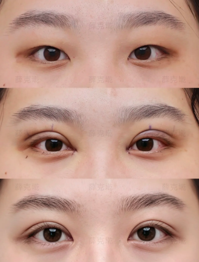 福州双眼皮做得最好的医生是谁？薛克墘、徐丽丽、李传生、察鹏飞、李丹