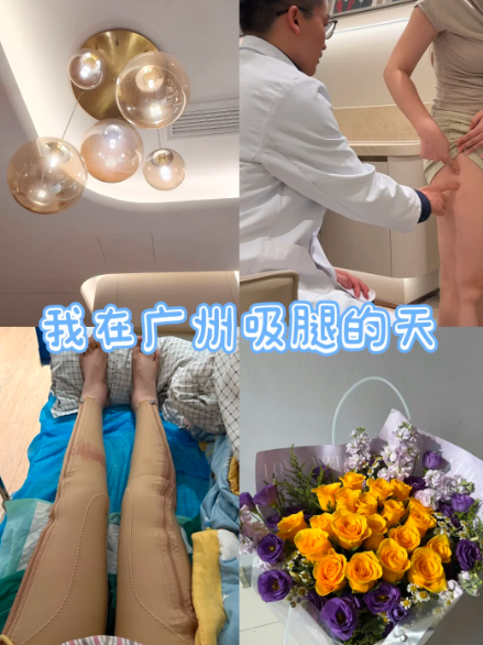 广州吸脂最好的专家TOP5：王世虎、邓晟华、宋彦、周滔、李业宏