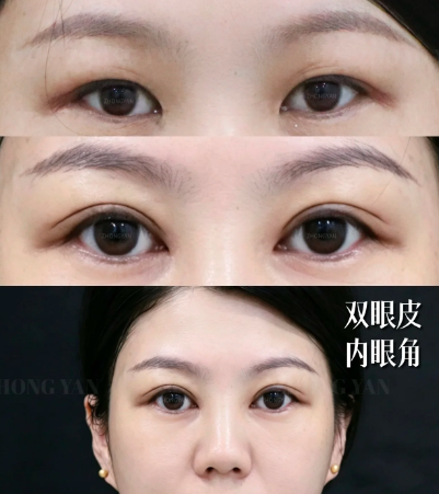 长春双眼皮医生韩柏宏、刘莉、张连波、刘晓吉谁双眼皮技术最好?