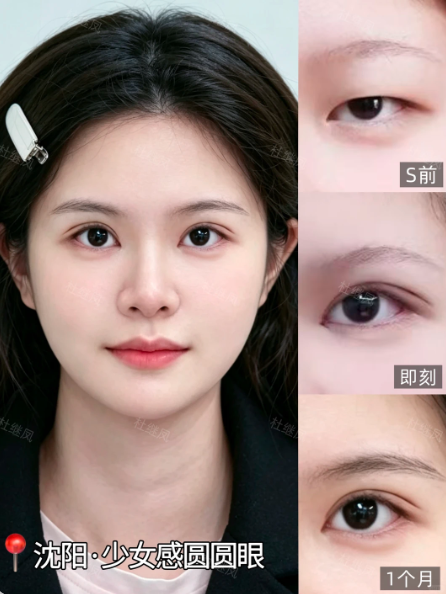 2026沈阳割双眼皮哪个医生好?王广为、王莉莉、孟强、刘海滨、杜继凤