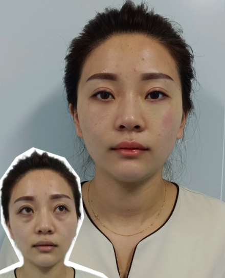 海口刘申松祛眼袋技术怎么样？海口刘申松做祛眼袋术后效果好不好？
