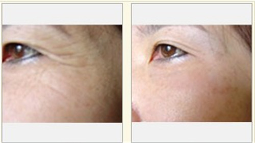 激光除皱价格是多少？面部激光除皱眼部激光除皱价格是多少？