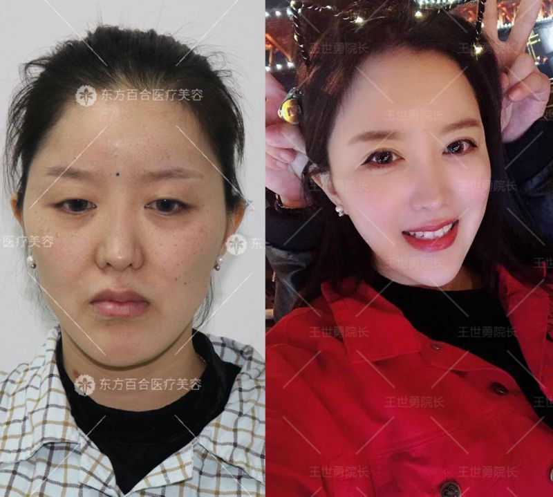 王世勇是中国知名的双眼皮整形专家吗？