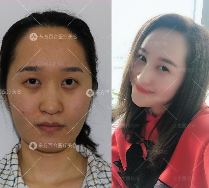 王世勇是中国知名的双眼皮整形专家吗？