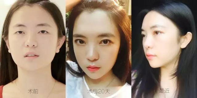 眼综合术后可以熬夜吗？眼部整形手术后可以熬夜吗