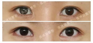 张冰洁做内眼角修复效果怎么样？张冰洁做内眼角修复好吗？