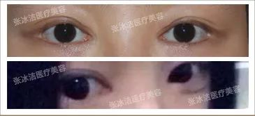 张冰洁做内眼角修复效果怎么样？张冰洁做内眼角修复好吗？