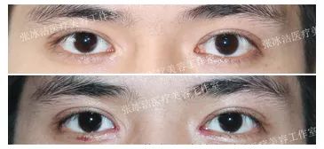 张冰洁做内眼角修复效果怎么样？张冰洁做内眼角修复好吗？