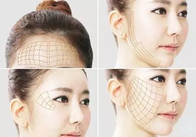 深圳妍熙李静做的面部线雕提升怎么样？