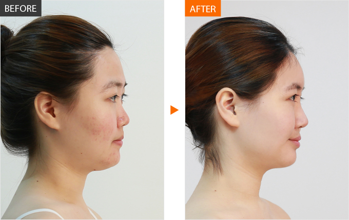 南京面部填充最好的整形医院和整形医生排行榜 南京面部填充哪个医生和医院做的好？面