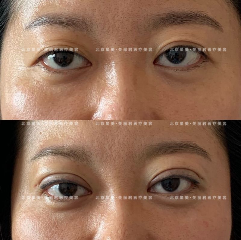 北京星美医疗美容双眼皮修复专家刘勇怎么样？