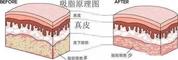 大腿吸脂后出现凹凸不平好后悔啊？可以修复吗？