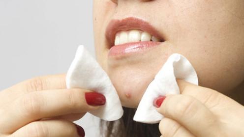 脸上长痘痘怎么调理？激光可以去痘痘吗？