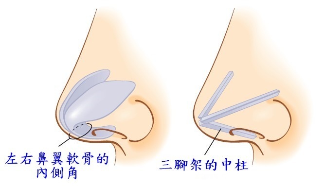 鼻整形奥秘（六）：鼻部軟骨(上側軟骨、鼻翼軟骨、鼻中膈軟骨)的利用是在哪一段?