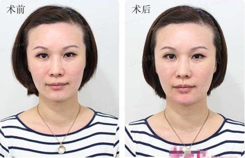 玻尿酸有哪些牌子?进口玻尿酸和国产玻尿酸哪个好? 玻尿酸有哪些牌子?进口玻尿酸和国产玻尿酸哪个好?