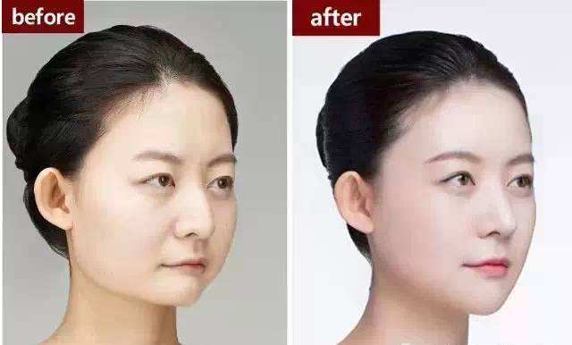 如何降低玻尿酸注射造成失明的风险呢？