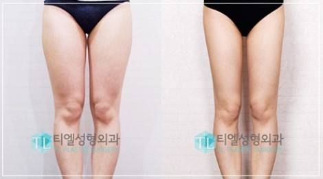 上海吸脂抽脂和脂肪填充哪个医生技术好?上海吸脂脂肪填充最好的医生排名 上海吸脂抽脂和脂肪填充哪个医生技术好?上海吸脂脂肪填充最好的医生排名