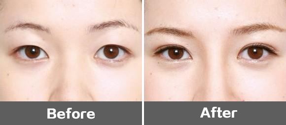 武汉同济医院双眼皮修复谁最好?王海平和曹玮哪个更好?武汉双眼皮修复预约 武汉同济医院双眼皮修复谁最好?王海平和曹玮哪个更好?武汉双眼皮修复预约