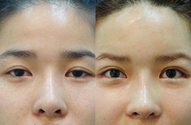 内眼角开大了后悔怎么办？内眼角修复最好的专家排名简介