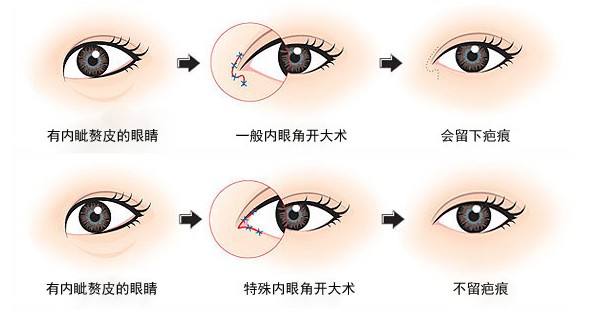 内眼角开大了后悔怎么办？内眼角修复最好的专家排名简介