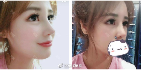 上海华美谢卫国、百达丽韩嘉毅、伊莱美钱玉鑫隆鼻&鼻综合&鼻修复对比 上海华美谢卫国、百达丽韩嘉毅、伊莱美钱玉鑫隆鼻&鼻综合&鼻修复对比