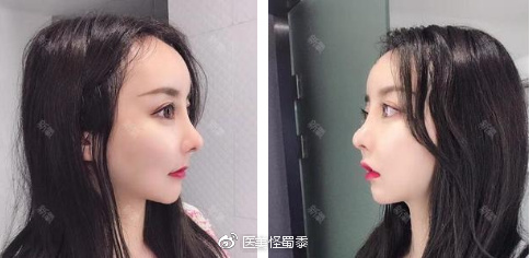 上海华美谢卫国、百达丽韩嘉毅、伊莱美钱玉鑫隆鼻&鼻综合&鼻修复对比 上海华美谢卫国、百达丽韩嘉毅、伊莱美钱玉鑫隆鼻&鼻综合&鼻修复对比