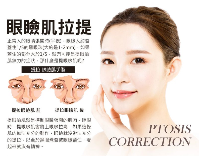 眼睑肌无力怎么办？眼睑肌提拉塑造完美女神