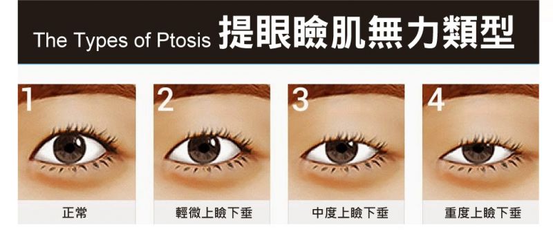 眼睑肌无力怎么办？眼睑肌提拉塑造完美女神