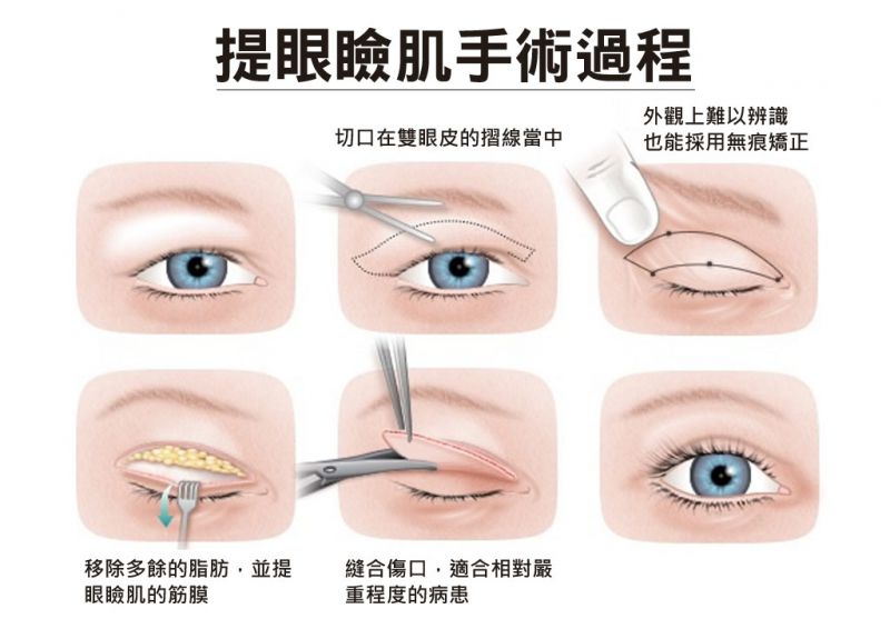 眼睑肌无力怎么办？眼睑肌提拉塑造完美女神
