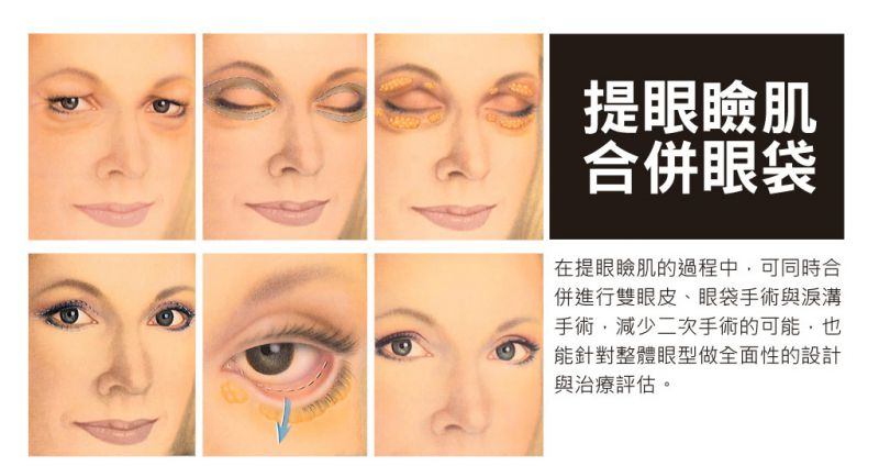 眼睑肌无力怎么办？眼睑肌提拉塑造完美女神