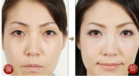 眼修复专家王世勇刘风卓张冰洁王振军白永辉谁更厉害？双眼皮修复预约