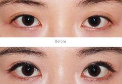 眼修复专家王世勇刘风卓张冰洁王振军白永辉谁更厉害？双眼皮修复预约