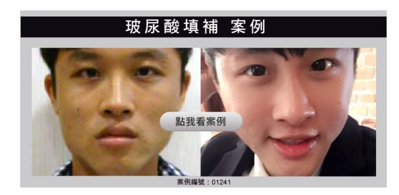 玻尿酸填充泪沟大分子还是小分子好？填充泪沟玻尿酸品牌大全