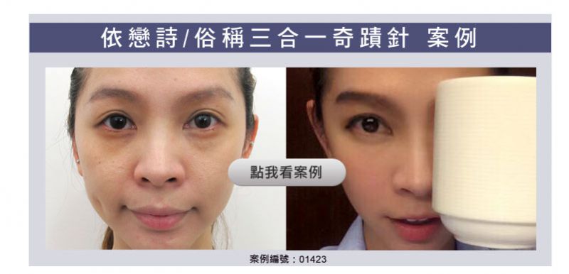 玻尿酸填充泪沟大分子还是小分子好？填充泪沟玻尿酸品牌大全