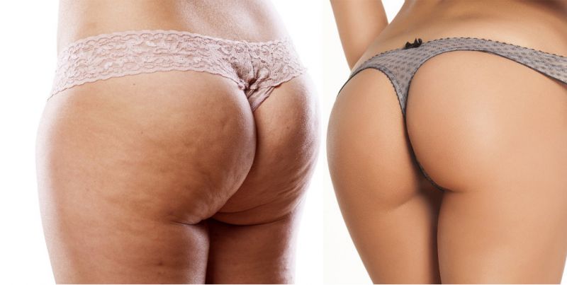 抽脂失败后悔，凹凸不平怎么避免？抽脂无效的原因是什么？