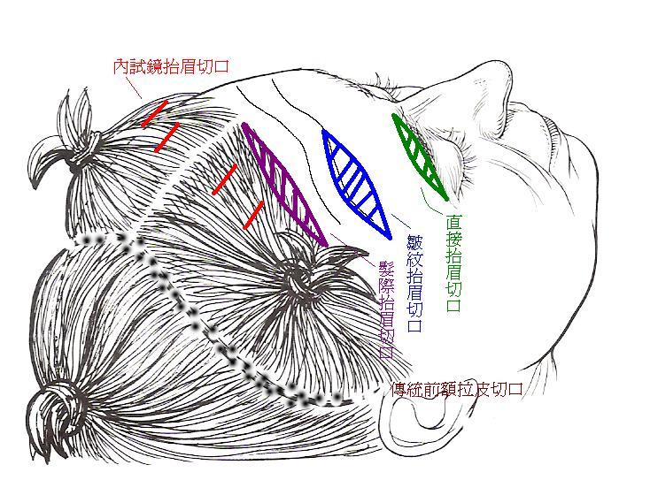 上额拉皮（上面部拉皮）的手术方式和术后保养