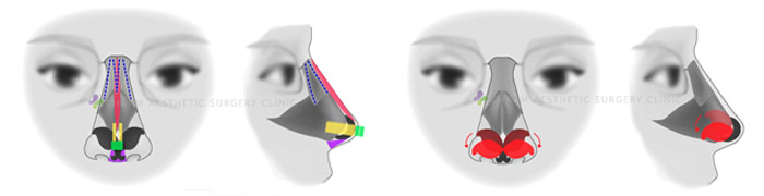 隆鼻失败之鼻整形手术后挛缩、鼻头朝天变形怎么修复？